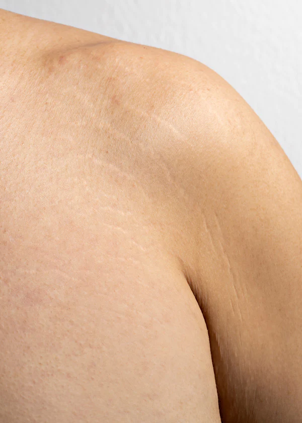 موارد استفاده از کرم استرچ مارک