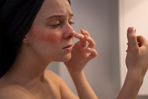 سوختگی بعد از میکرونیدلینگ