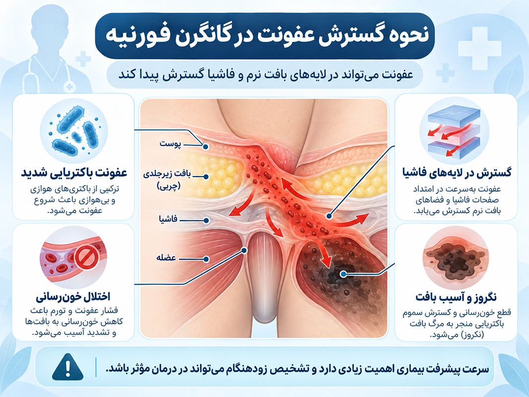 اینفوگرافیک نحوه گسترش عفونت در گانگرن فورنیه با نمایش درگیری پوست، بافت زیرجلدی، فاشیا، اختلال خونرسانی و نکروز بافت