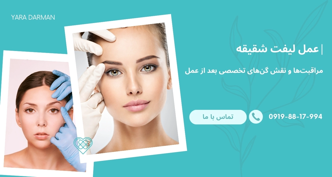 عمل لیفت شقیقه : راهنمای کامل، مزایا، مراقبتها و نکات بعد از عمل