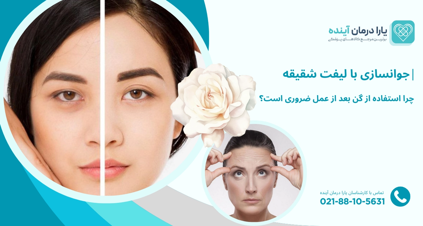 عمل لیفت شقیقه : راهنمای کامل، مزایا، مراقبتها و نکات بعد از عمل