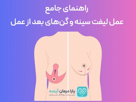راهنمای جامع عمل لیفت سینه و گن‌های بعد از عمل