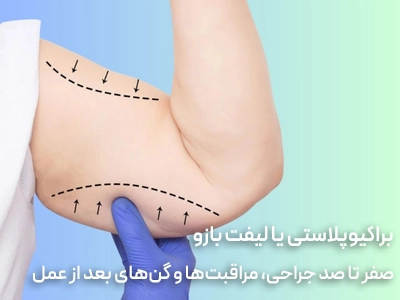 براکیوپلاستی یا لیفت بازو: صفر تا صد جراحی، مراقبت‌ها و گن‌های بعد از عمل